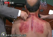 20100824北京养生堂视频：王敬讲刮痧治颈椎病